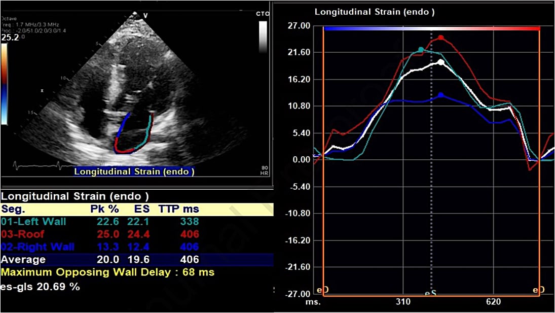 Speckle tracking echocardiography illustrating global longitudinal