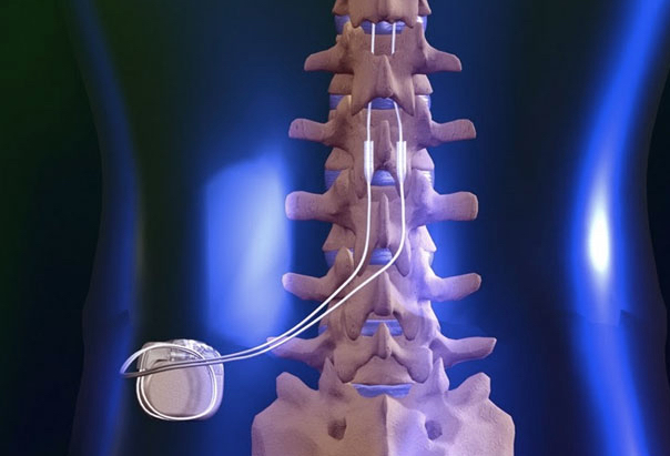 About Spinal Cord Stimulation - Boston Scientific