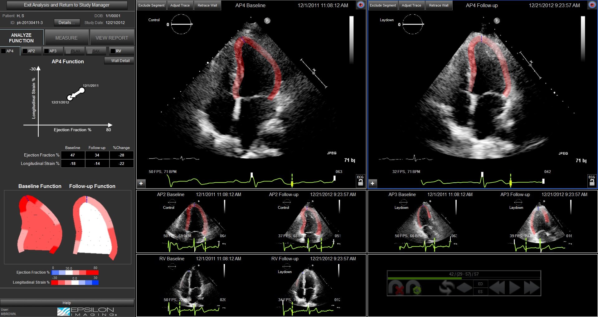 Case Study: Using Strain Echo to Recognize Cardiotoxicity from