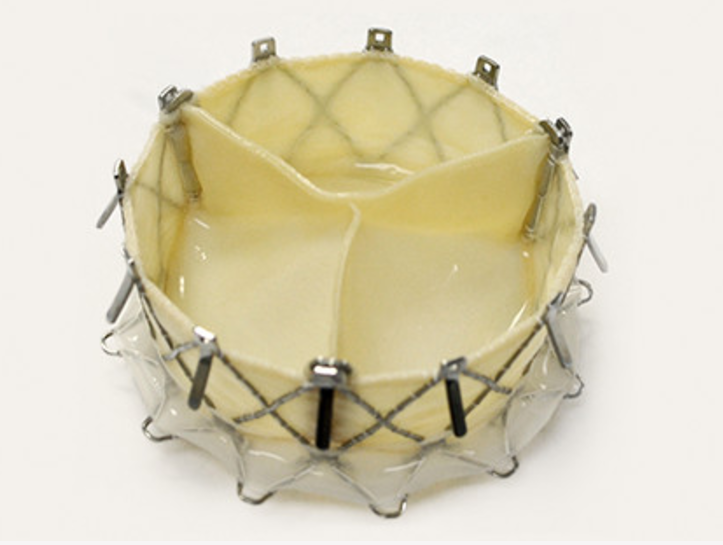 First U.S. Transcatheter Tricuspid NaviGate Valve Successfully