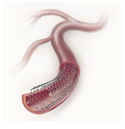 FDA Discusses Recommendation for First Drug-Eluting Peripheral