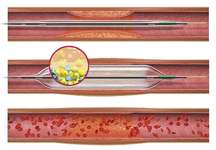 Handbook of Drug-Eluting Stents 英語版｜Handbook of Drug-Eluting