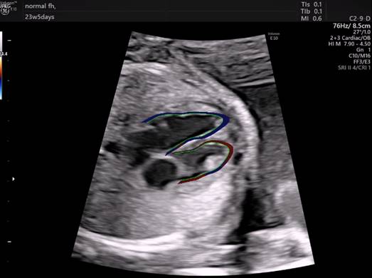 Cardiac Ultrasound Software Streamlines Fetal Heart Exams | DAIC