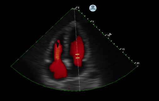 Innovative Cardiovascular Ultrasound Solutions Showcased at ASE Scientific  Sessions | DAIC