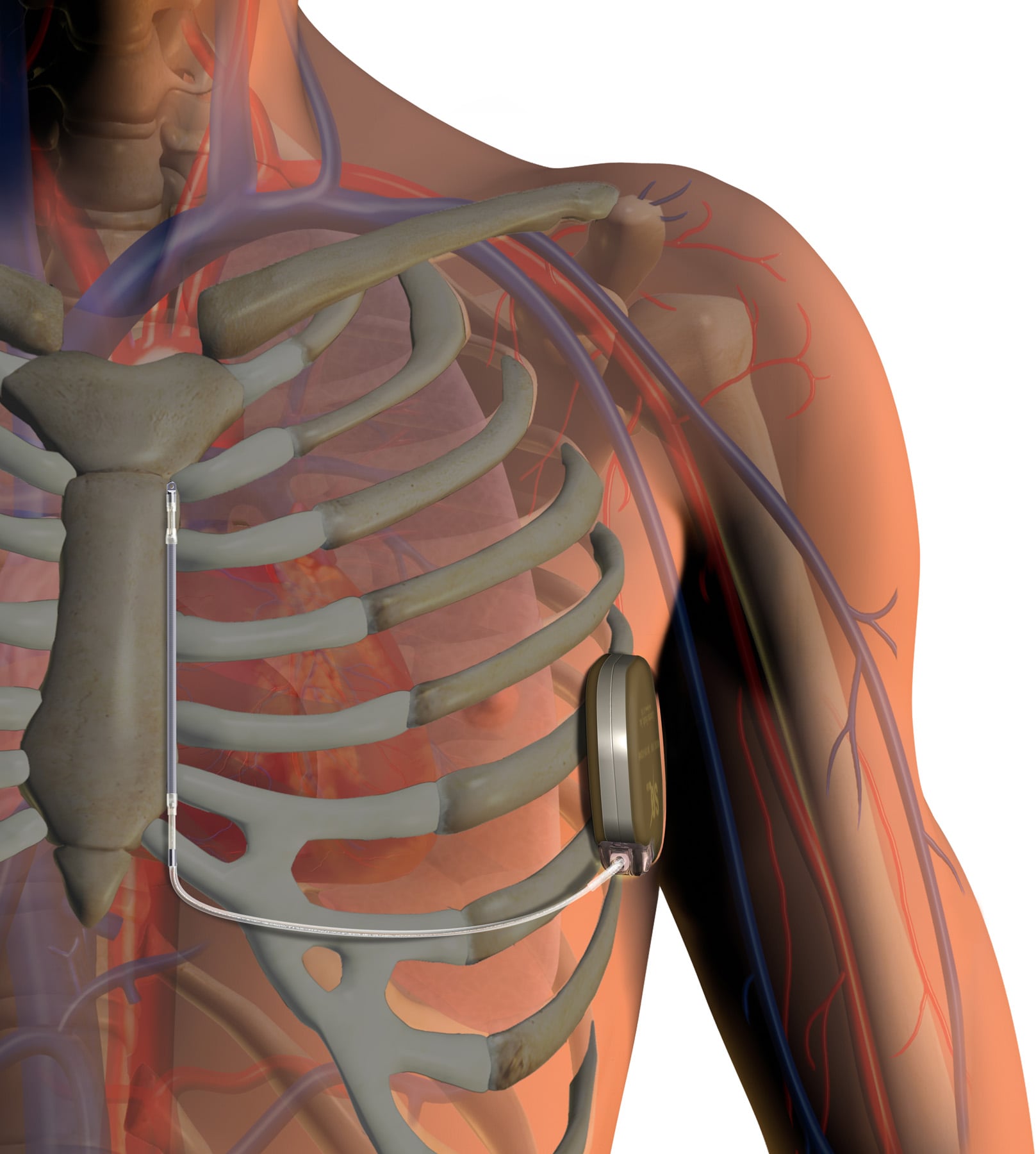 Nearly All ICD Implants Performed on Insured Patients | DAIC