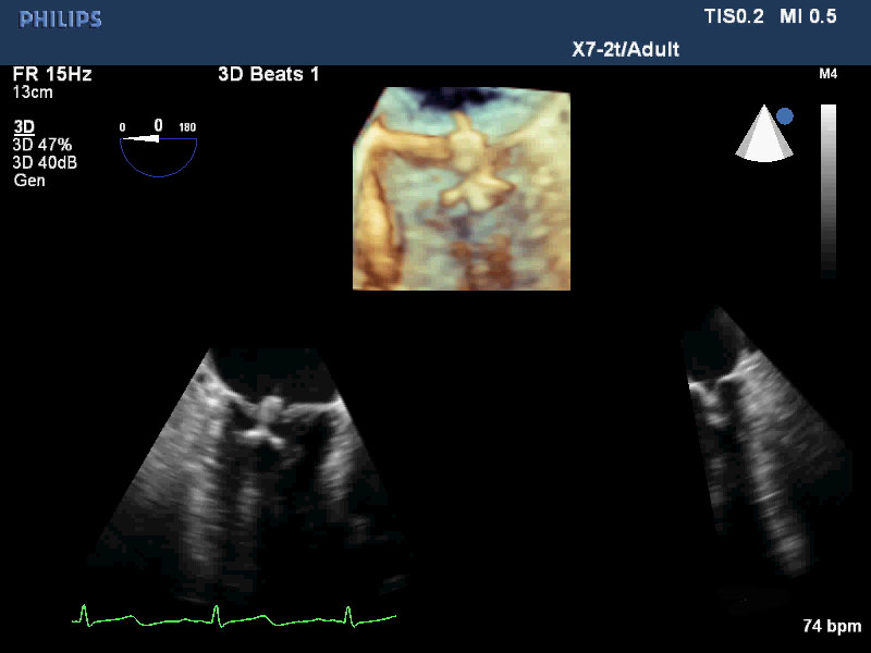 Advances in Transesophageal Echo | DAIC