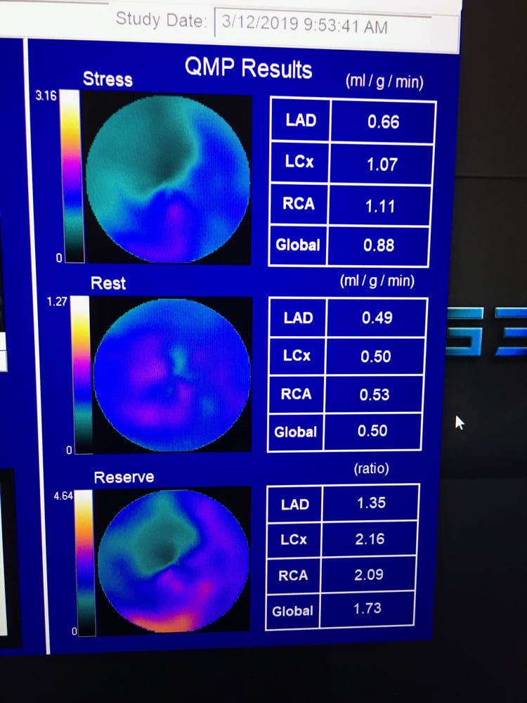 One of the newer technologies discussed in sessions at ASNC 2019 is the use of quantitative myocardial perfusion (QMP) flow reserve to enhance PET imaging. This is an example of software to perform this from the vendor Cardiovascular Imaging Technologies on the expo floor. Flow reserve can help show the severity of the ischemia detected on a PET scan and help show its cause and course of therapy. It takes the stress QMP divided by the rest scan QMP to offer a ratio for the flow reserve. #ASNC #ASNC19