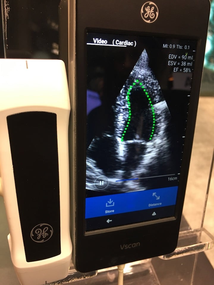 Dia AI software performs an auto ejection fraction measurement on a GE Healthcare Vscan POCUS ultrasound using artificial intelligence. Photo by Dave Fornell