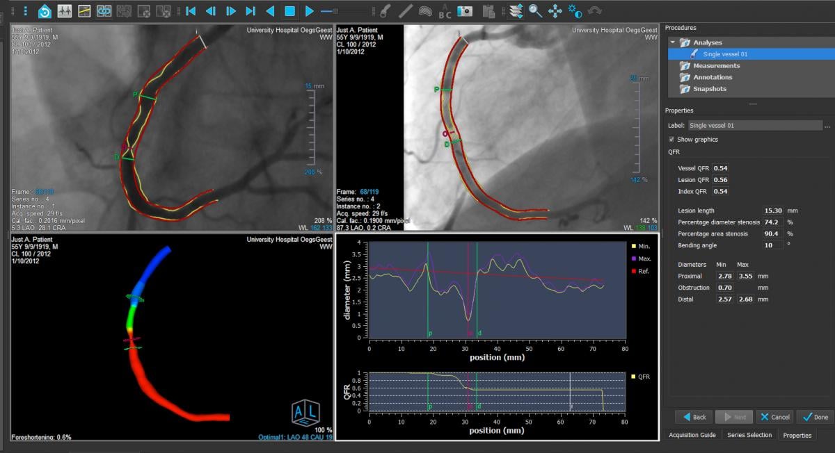 The is the FDA-cleared Medis FFR-Angio QCA software. It uses rotational angiography image acquisitions while the patient is on the table in the cath lab to analyze coronary vessel segments for a derived FFR ratio without the use of pressure wires. It also creates a 3-D reconstruction of the vessel showing a color code for the FFR values to help determine if a stent is needed and where is should be placed. Photo courtesy of Medis.