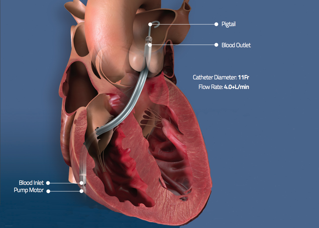Impella RP is now FDFA cleared for use in COVID-19 patients with right side heart failure or due to pulmonary embolism.