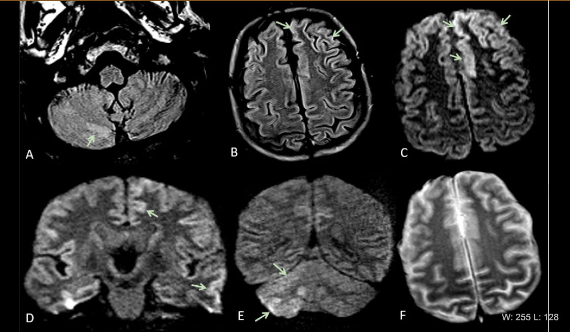 This is Figure 2 from the article in Radiology: Acute encephalopathy. A 60 year-old-man without history of seizures presenting with convulsion. (A-B) Multifocal areas of FLAIR hyperintensity in the right cerebellum (arrows in A), left anterior cingular cortex and superior frontal gyrus (arrows in B). (C-D) Restricted diffusion in the left anterior cingulate cortex, superior frontal and middle temporal gyrus (arrows in D) and right cerebellum (arrows in E), consistent with cerebellar diaschisis. F) No hemosiderin deposits in gradient echo sequences. Vascular impact of COVID-19. 