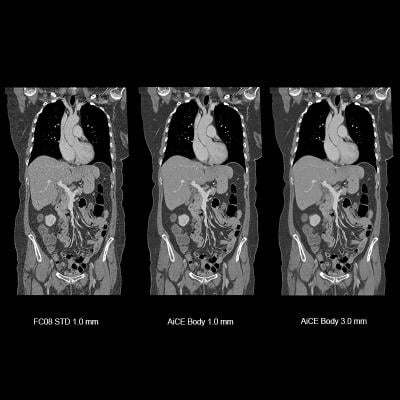 Copmparison of artificial intelligence assisted CT image reconstruction for low-dose CT scans using the Canon Aquilion Precision CT AiCE software