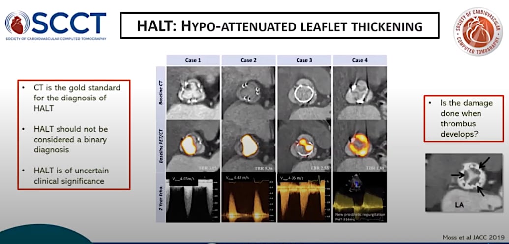 Hyper-attenuated leaflet thickening (HALT) on CT imaging due to thrombus formation on the valve leaflets has been a big concern but data from several studies shows it appears to be benign.