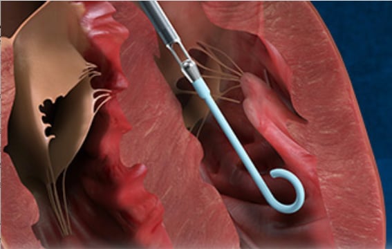 The Abiomed Impella catheter heart pump is being tested in the DTU Trial.