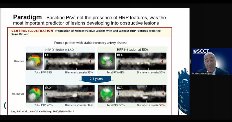 CT coronary plaque assessment software used in the PARADIGM trial showed low attenuation plaques are a more important predictor of cardiac events than calcium scores. Here the trial data is being presented at SCCT 2020 by Matthew J. Budoff, M.D., FACC, professor of medicine at the David Geffen School of Medicine, and director of cardiac CT Harbor-UCLA Medical Center. 