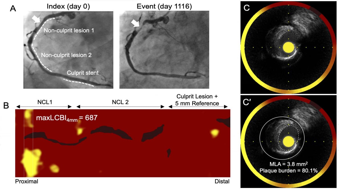 An example if NIRS-IVUS intravascular imaging technology from the PROSPECT II trial showing 3 lesions in coronary artery and the technology chemogram showing areas of high lipid content in the vessel wall in yellow. #TCTconnect #TCT2020 