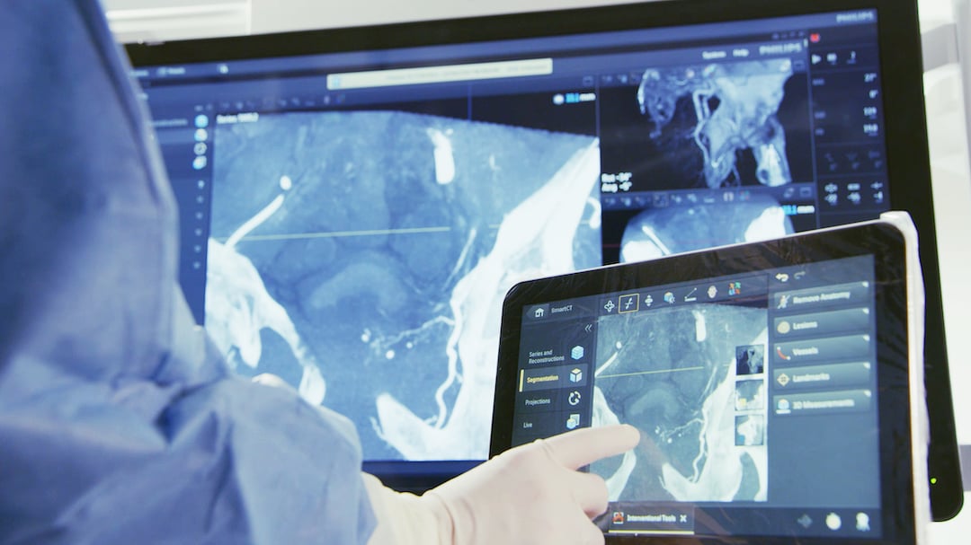 Philips Azurion SmartCT rotational angiography feature allows easy CT-like image creation tableside in the cath lab. 