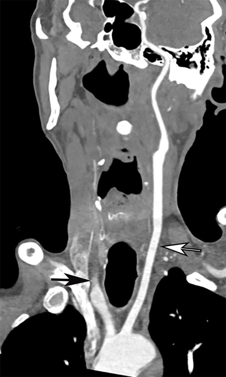 Common carotid artery (CCA) occlusion in a 56-year-old woman with neurologic deficits who had been hospitalized with COVID-19. Coronal three-dimensional maximum intensity projection reformatted image of the head and neck show an abrupt cutoff at the origin of the CCA (black arrow). The left carotid vasculature is well opacified with intravenous contrast material (white arrow). Image courtesy of Margarita Revzin et al. 