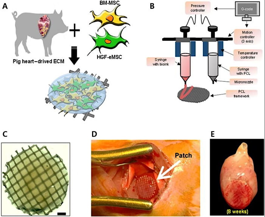 3D printed patch filled with stem cells may be able to repair cardiac infarcts.