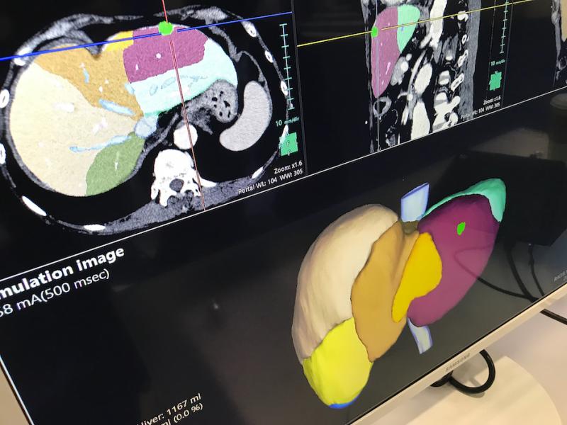 Example from Fujifilm of an automated liver segmentation application for CT scans. This is used for surgical resection planning and the images can be used during the OR procedure to aid guidance. #HIMSS #HIMSS21 