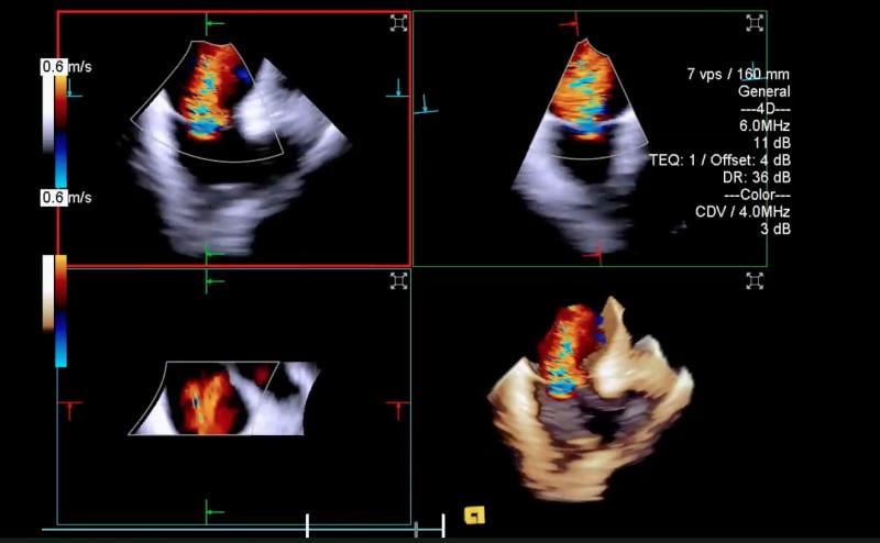 An example of intra-cardiac echo (ICE) imaging from Siemens Healthineers showing color flow Doppler with severe valve regurgitation. ICE has seen wider use in transcatheter structural heart  procedures because, unlike TEE, it can be used without deeper sedation of anesthesia.