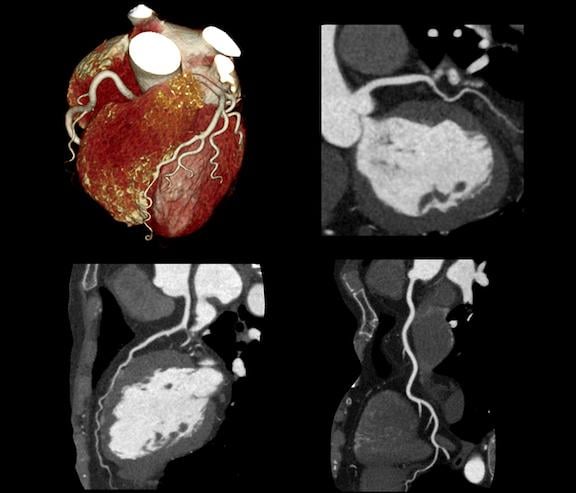 An example of a cardiac CT scan showing a 3-D reconstriction of the heart showing a stented vessel, and reformatted images showing the stented coronary artery with restenosis from different views. This was imaged using a Canon Aquilion Prime CT system.