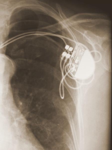 EP lab pacemakers ICD defibrillators cardioverter implantable