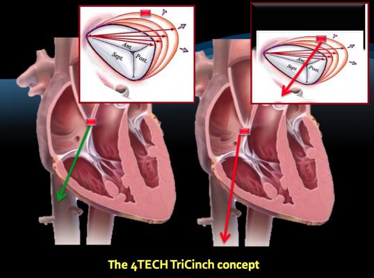 First TriCinch Coil Tricuspid Repair Systems Implanted in U.S.