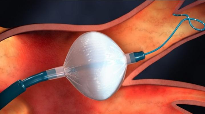 The Medtronic Arctic Front cryoballoon balloon was used a a front-line treatment of AF in the EARLY-AF trial. It was found to be better than anti-arrhythmic drugs in preventing the recurrence of abnormal heart rhythm (atrial tachyarrhythmia, atrial fibrillation), and improve patient well-being.  #AHA #AHA2020 #AHA20
