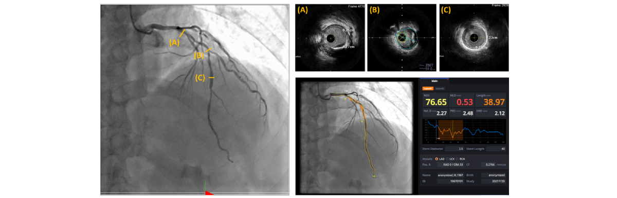A representative case in which artificial intelligence–based quantitative coronary angiography (AI-QCA) showed a good correlation with intravascular ultrasound (IVUS) observation. %DS: percent diameter stenosis; DRD: distal reference diameter; LAD: left anterior descending artery; LCX: left circumflex artery; MLD: minimal luminal diameter; PRD: proximal reference diameter; RCA: right coronary artery; Ref.D: reference diameter. 