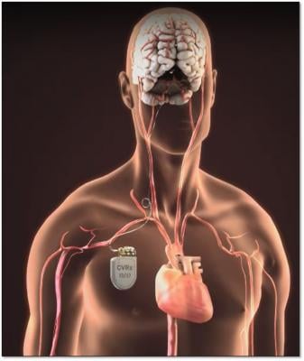 FDA Approves Barostim Neo System for Advanced Heart Failure Patients. Similar to a pacemaker, the Barostim Neo System uses a pulse generator implanted below the collar bone with a lead that attaches to the carotid artery in the neck. It delivers electrical impulses to baroreceptors in the neck, which sense how blood is flowing through the carotid arteries and relays information to the brain. The brain, in turn, sends signals to the heart and blood vessels that relax the blood vessels.