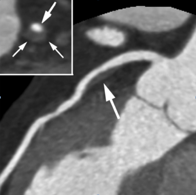 Readers of cardiac computed tomography (CT) exams often over estimate the risk if coronary artery disease (CAD) according to a new core-lab analysis from the PROMISE Trial. #RSNA17, #RSNA2017, #SCCT