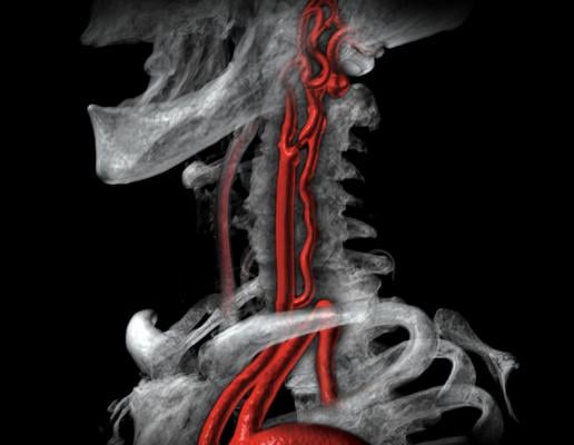 A 3-D CT reconstructed image showing a narrow lesion at the carotid bifurcation. ACST-2 was the largest trial to compare the long-term effect of carotid artery stenting (CAS) and carotid endarterectomy (CEA) on stroke in asymptomatic patients with a severely narrowed carotid artery that had not yet caused a stroke. Image by Canon