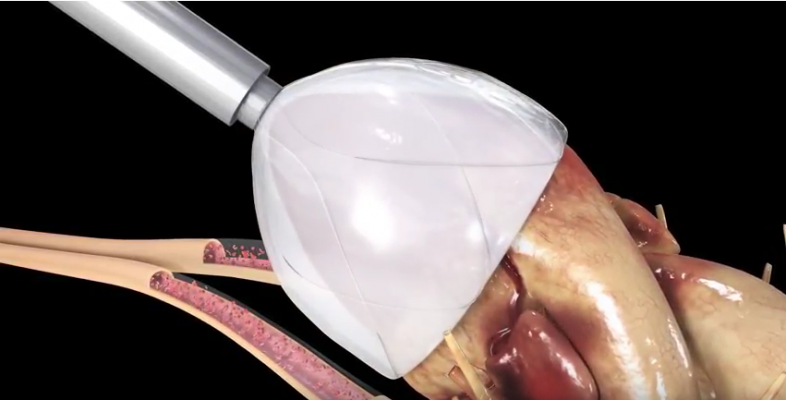 CorInnova Awarded Seminal Patent for Minimally Invasively-Delivered Soft Robotic Heart Device