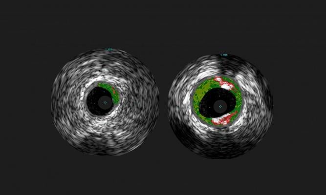 Shown are cross-sectional ultrasound images of coronary arteries from patients enrolled in the study.