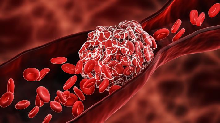 Lowering blood pressure after clot removal may not be safe, and should be individualized, according to findings of the BEST II Trial presented during the American Stroke Association International Stroke Conference. Photo credit: Getty Images