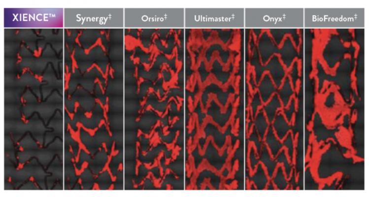 Comparison showing platelet adhesion to the surface of various coronary artery drug-eluting stents (DES) in a preclinical study that used aspirin only. Abbott said the Xience stent's fluoropolymer is significantly more anti-thrombotic than other DES.[2] 