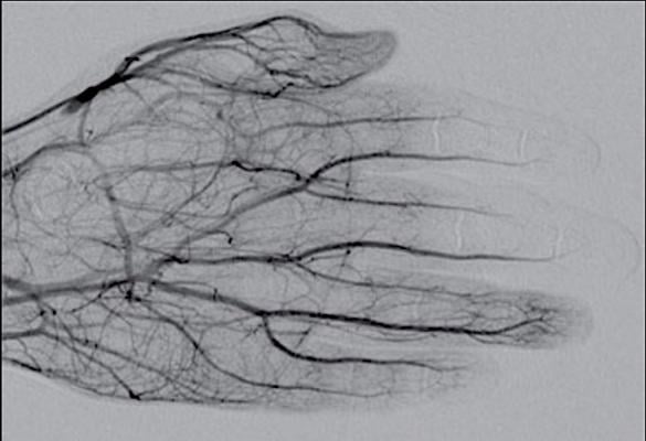 DSA image obtained approximately 24 hours after 1 mg/h IA tPA infusion, 500 U/h heparin via peripheral IV, and daily oral aspirin (81 mg) shows improved perfusion of digital arteries, albeit with suboptimal vascular blush of distal second and third phalanges. Photo courtesy of ARRS