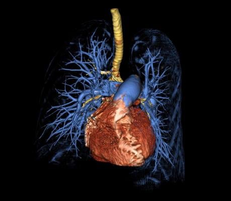Computed tomography 3D surface rendering of the lungs and heart from a patient with pulmonary arterial hypertension demonstrating trachea and major airways (yellow), an enlarged heart (red), enlarged main pulmonary artery (large blue vessel on top of heart) and thinning of the peripheral pulmonary vessels (blue). Marcus Y. Chen, M.D., NHLBI