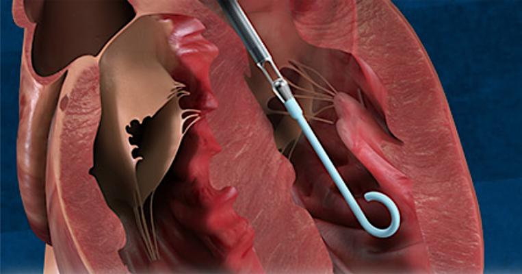 The Abiomed Impella was highlighted in several sessions at the 2020 TCT Connect conference. #TCT #TCT2020 #TCTconnect