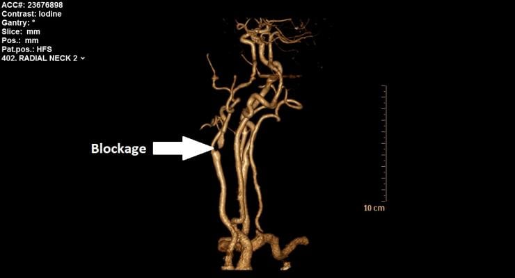 Computed tomography (CT) scan showing a 95 percent blockage in Marovic's carotid artery