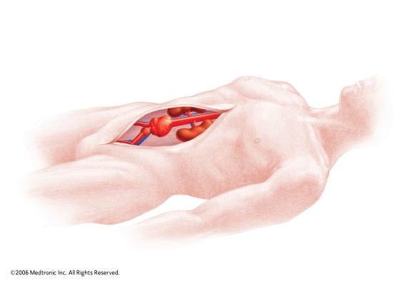Endurant IIs, stent graft system, abdominal aortic aneurysm, AAA