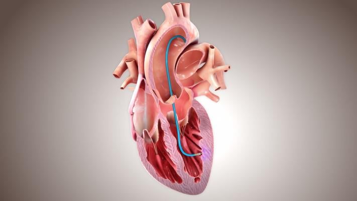 CardiAMP cell therapy-treated patients had 37% relative risk reduction in heart death equivalent (death, heart transplant, left ventricular assist device implantation) and 9% relative risk reduction in non-fatal major adverse cardiac and cerebrovascular events