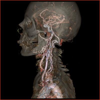 Medication Alone May Not Eliminate Stroke Risk in Carotid Atherosclerotic Stenosis Patients