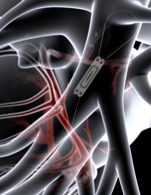 CardioMEMS is a wireless, battery-free sensor that is implanted into the pulmonary artery via a right heart catheterization procedure to transmit pulmonary artery pressures.