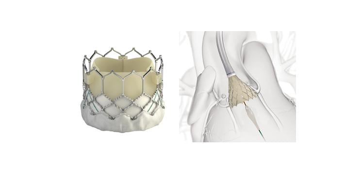 Local Anesthesia Safe and Effective for Intermediate- and High-Risk TAVR Patients
