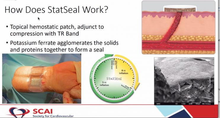 The STAT2 trial used a combination of the Biolife Statseal potassium ferrate hemostatic patch and a Terumo TR Band to reduce radial access arteriotomy site hemostasis by 50 percent.