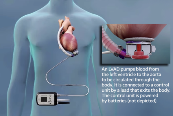 About one-fifth of implants of left ventricular-assist devices have the complication of right heart failure. Abbott Laboratories (adapted)