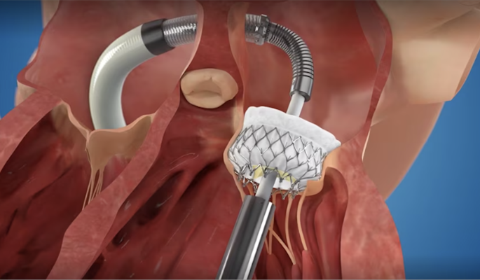 The Medtronic APOLLO Clinical Trial is evaluating the safety and efficacy of an investigative device called the Intrepid Transcatheter Mitral Valve Replacement System (TMVR) for moderate-to-severe or severe symptomatic mitral regurgitation (MR) in patients who may be unsuitable for approved transcatheter repair or surgery. 