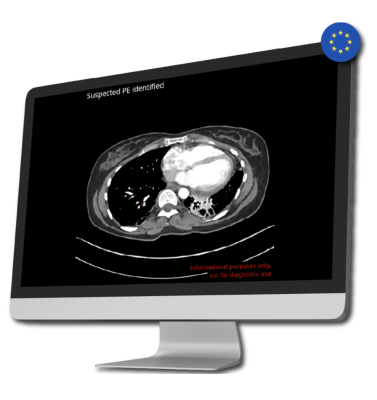 Medical imaging AI company receives approval for algorithms enabling incidental detection of pulmonary embolism and automatic assessment of stroke severity